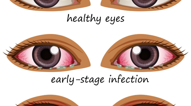 What Is Common Misdiagnosed As Pink Eye